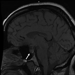 A Second Look at Cushing Disease