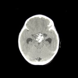 頭蓋咽頭腫における成長ホルモン補充：低肝制御および合併症研究の分析（Hypoccs）