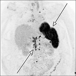 Diagnostic Challenges in a Case of Refractory Severe Hypercalcemia Due to  Splenic Sarcoidosis