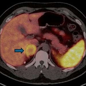 Early-Onset Sarcoma Case Study