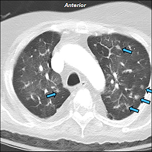 Ectopic Cushing Syndrome Secondary to Diffuse Idiopathic Neuroendocrine ...
