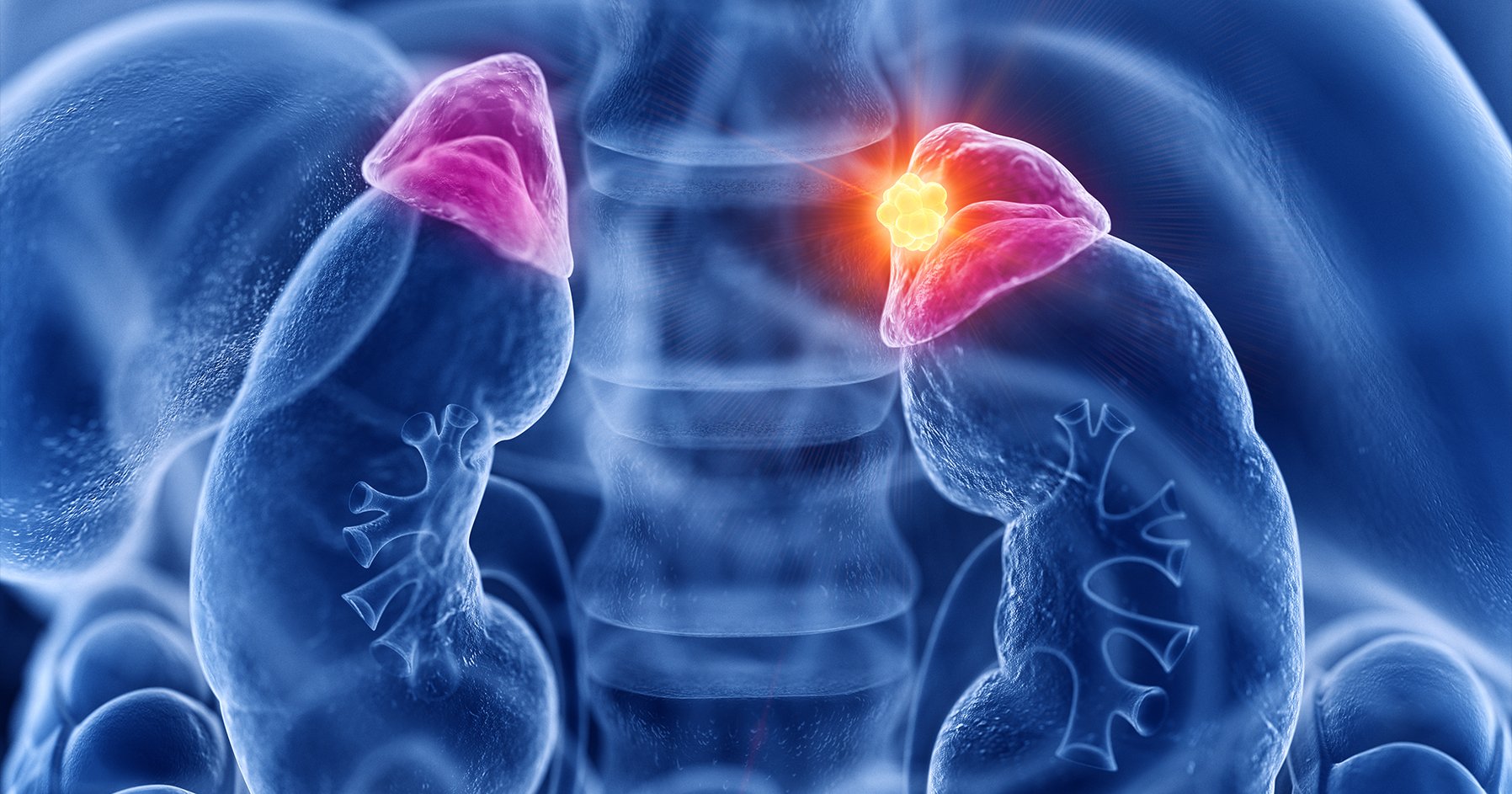 Adrenal Incidentaloma Endocrine Society