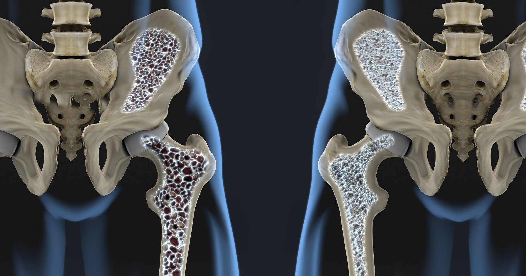 Dr. Fraser Discusses Osteoporosis and Good Bone Health