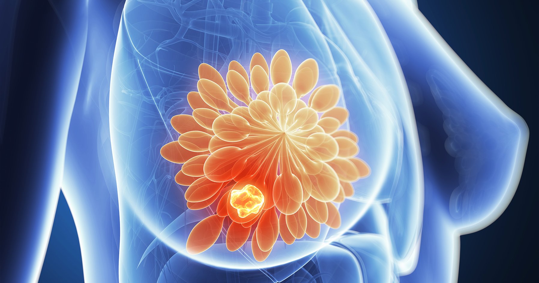 Image of breast cancer in the body.