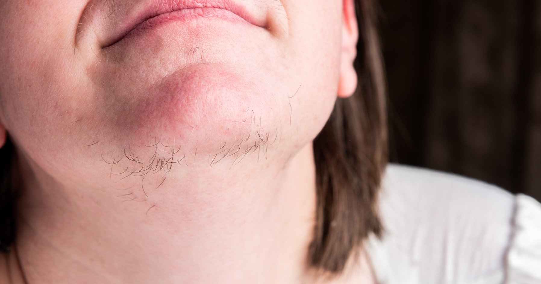Image of effects of hirsutism on body.