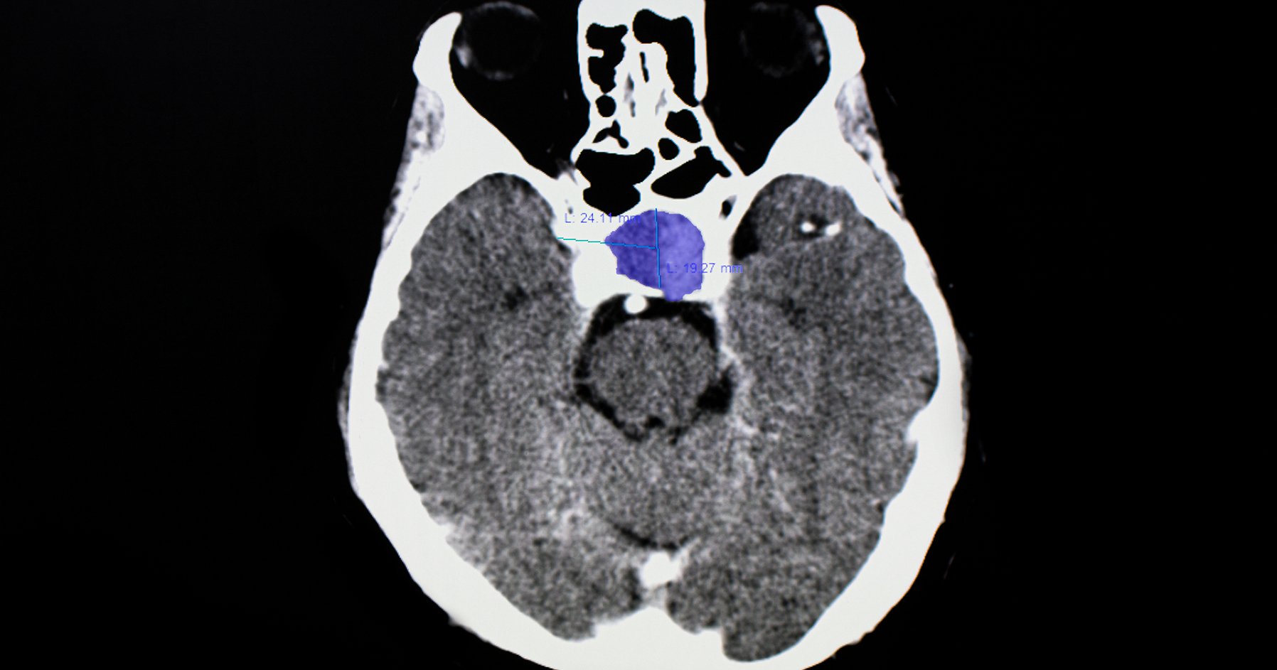 Image of a pituitary tumor in human body.