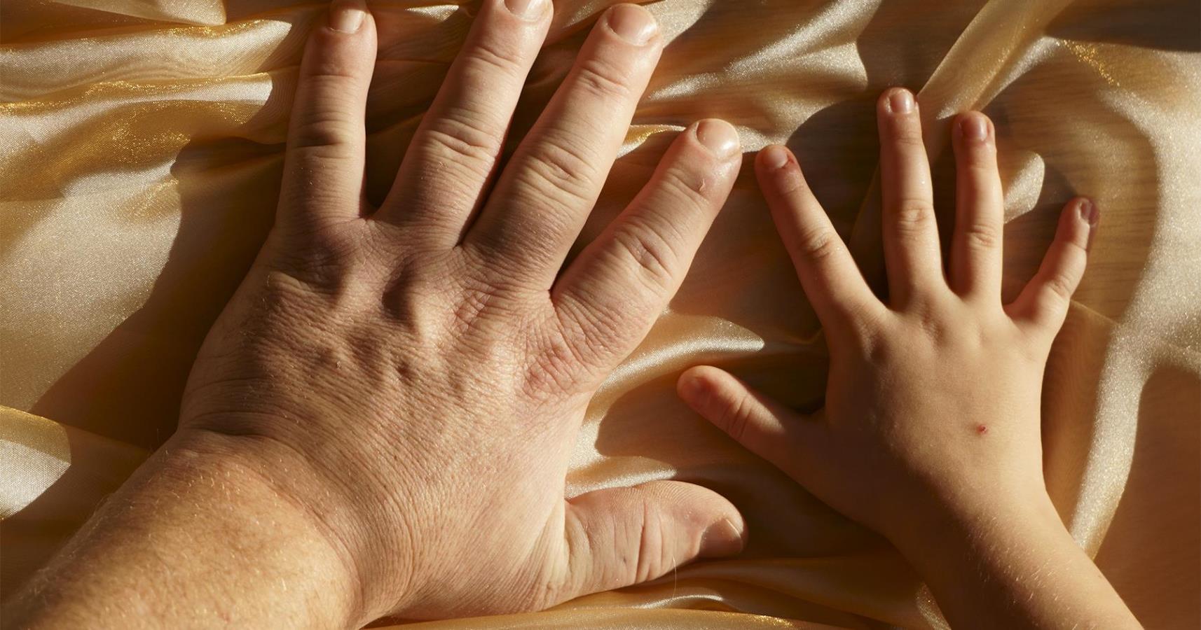 Image of a person with acromegaly comparing size of hands with a child.