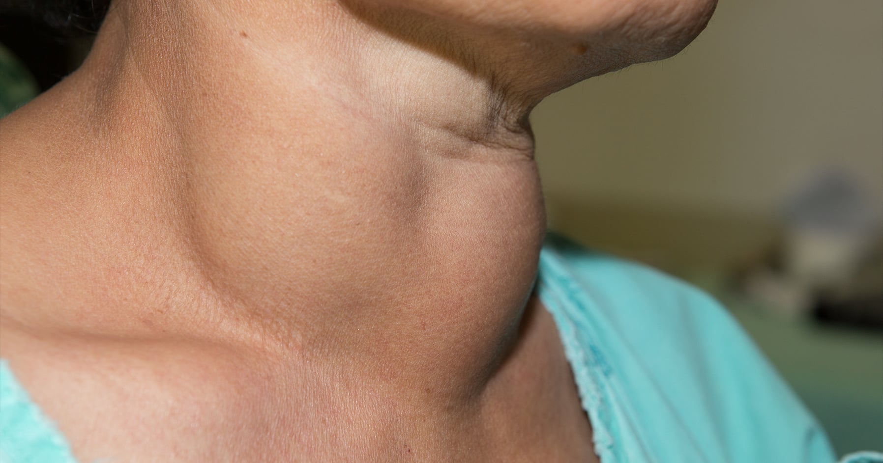Gouter Belt Goiter | Endocrine Society
