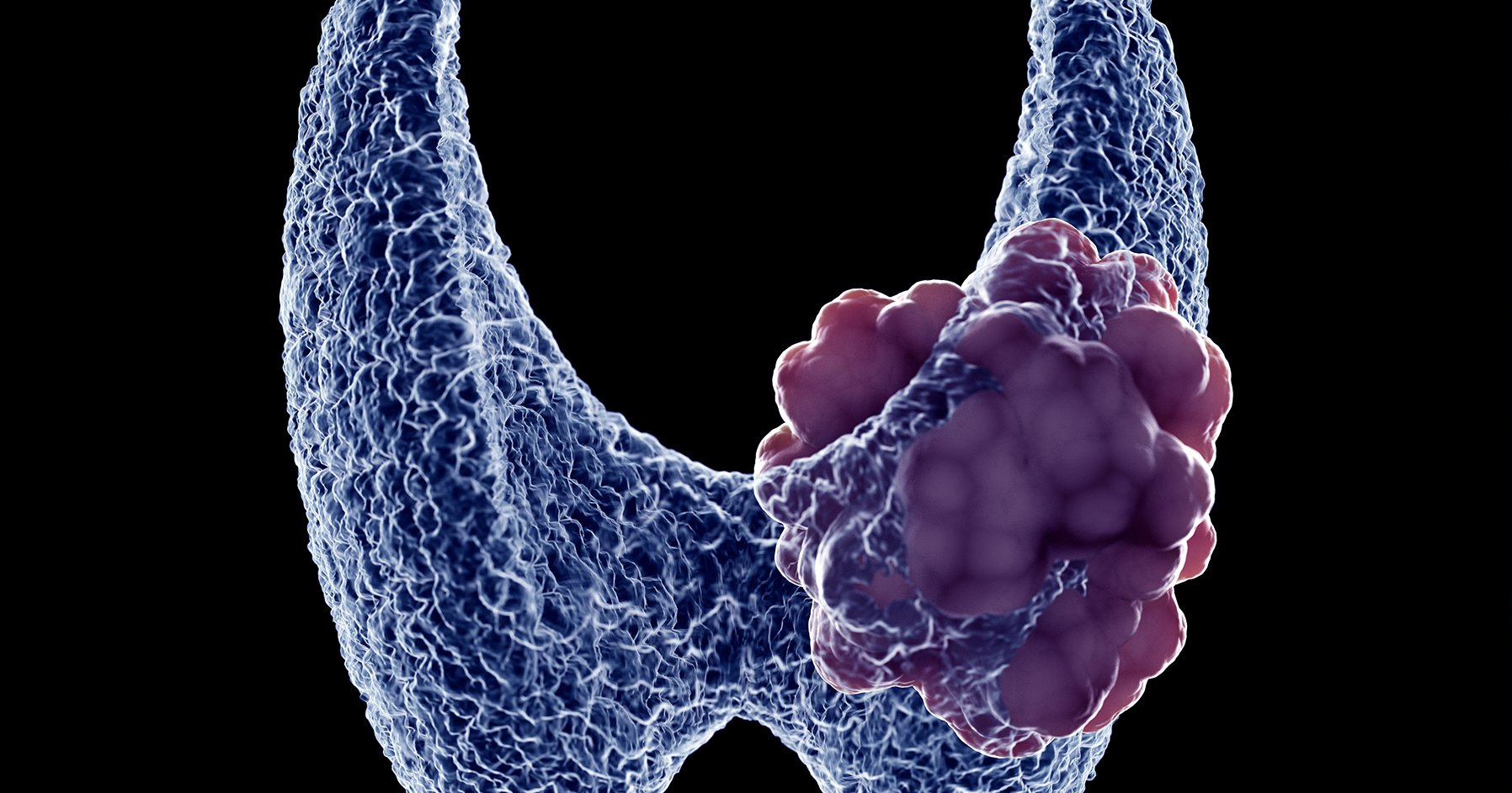 Image of thyroid dancer cells.